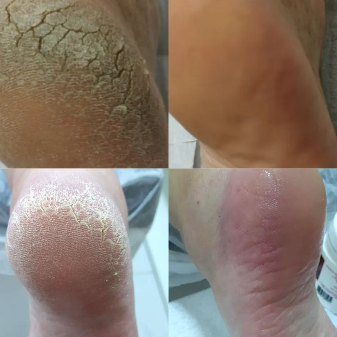 Creme De Calcanhar Antirrachadura