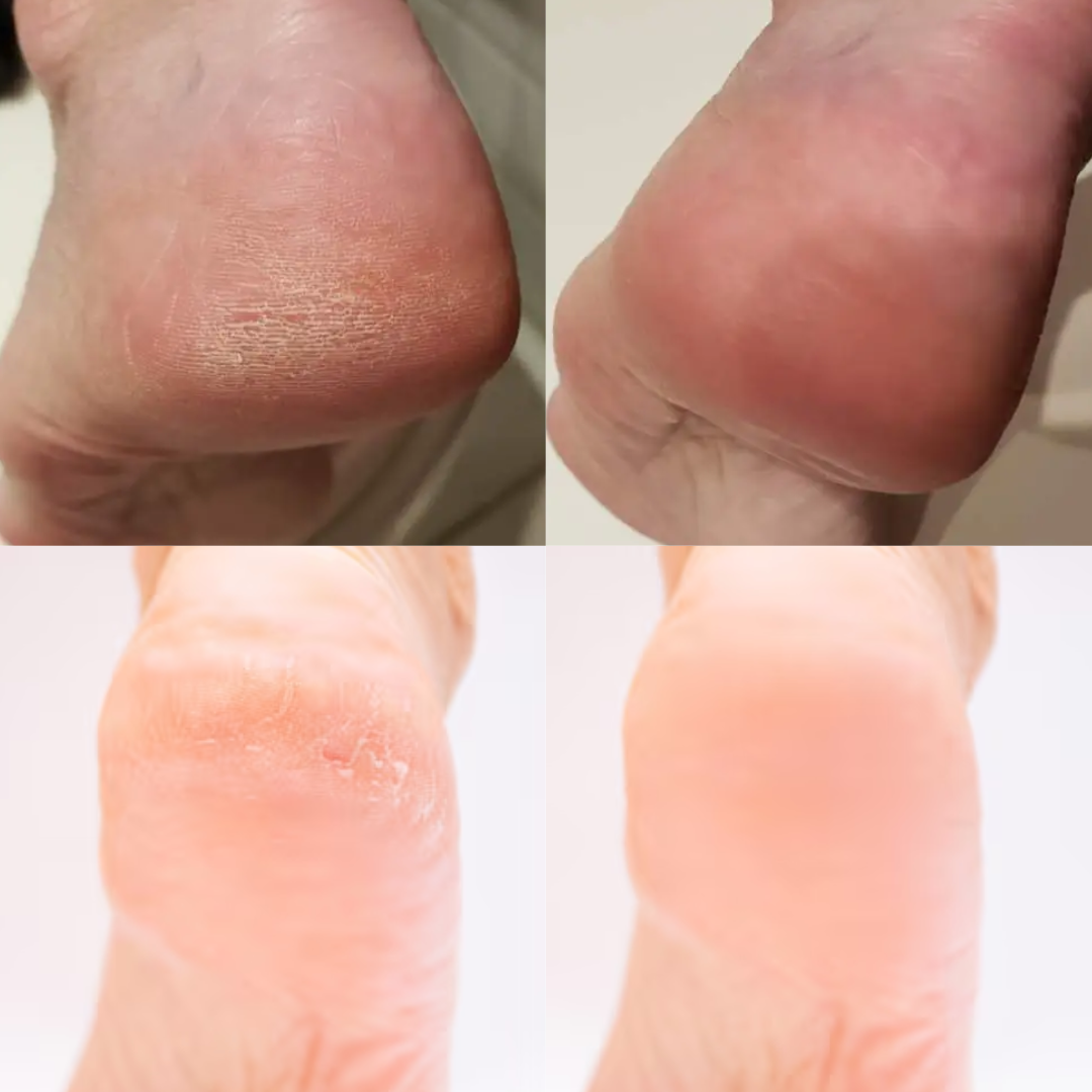 Creme De Calcanhar Antirrachadura